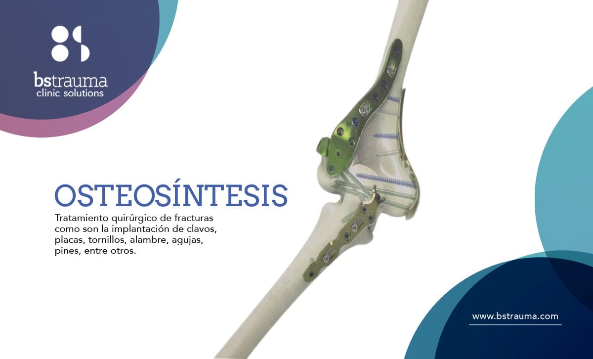 Osteosíntesis